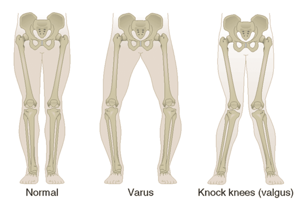 diagram of a normal, valgus and varus leg