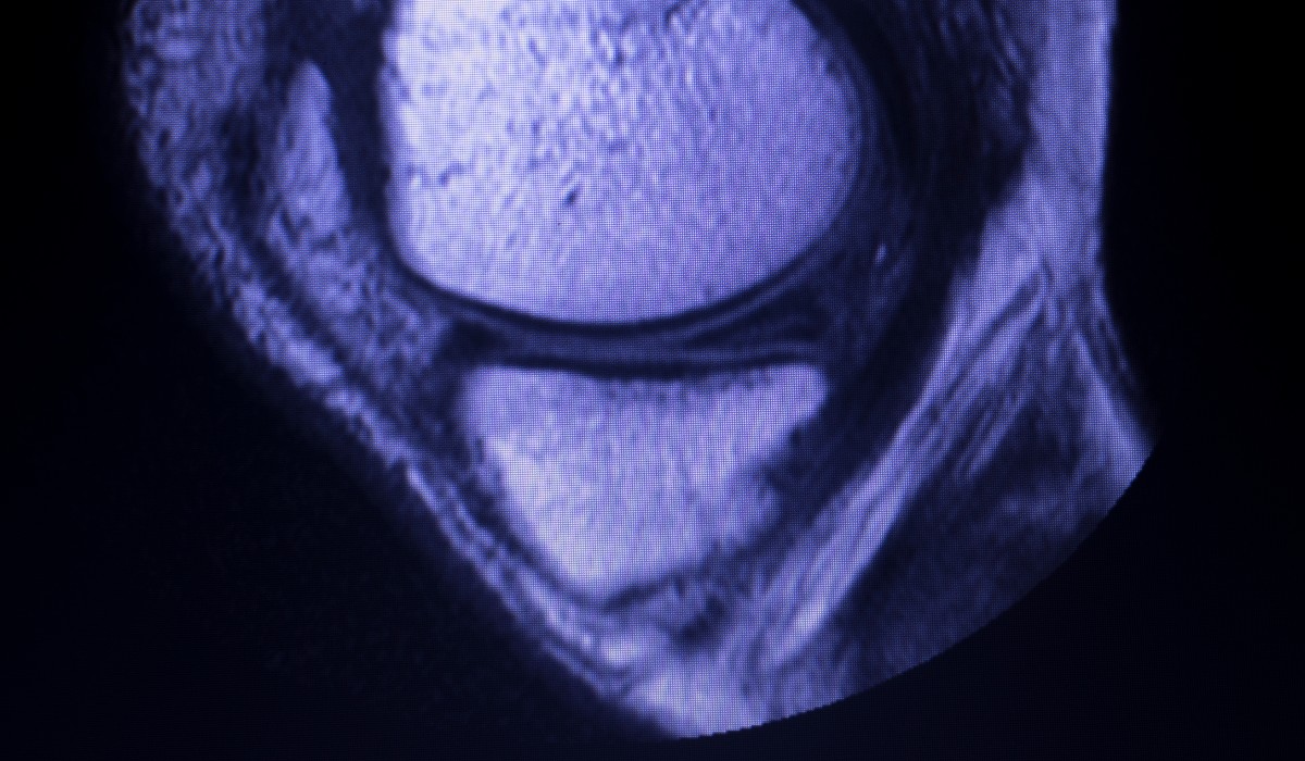 medical scan of a meniscus tear