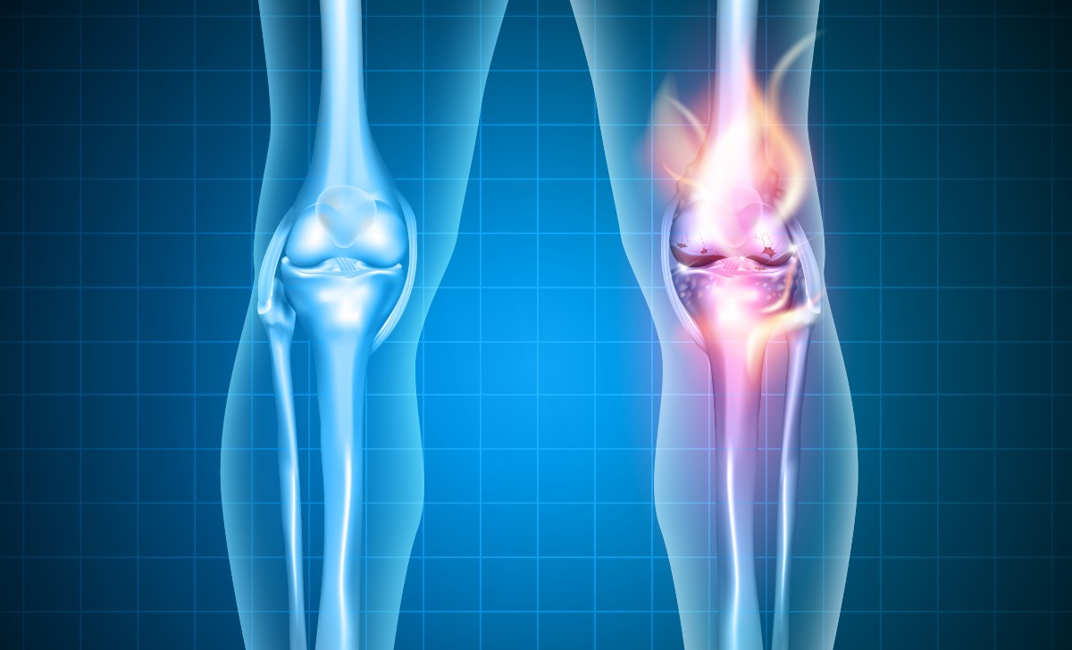 xray of a knee with osteoarthritis pain