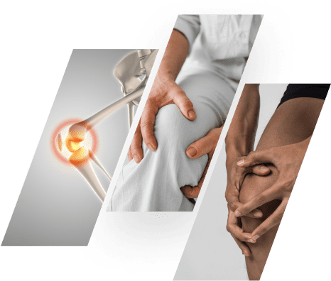 injury related osteoarthritis image