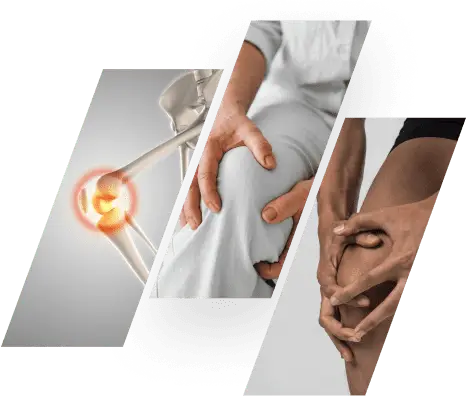 injury related osteoarthritis image