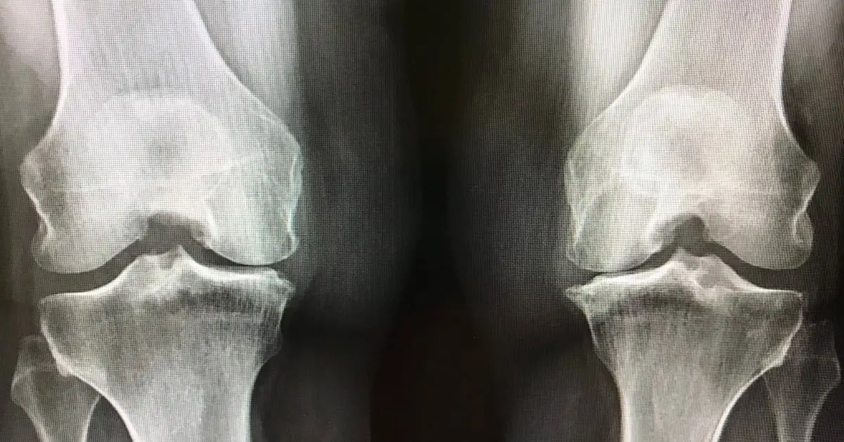 xray of knees