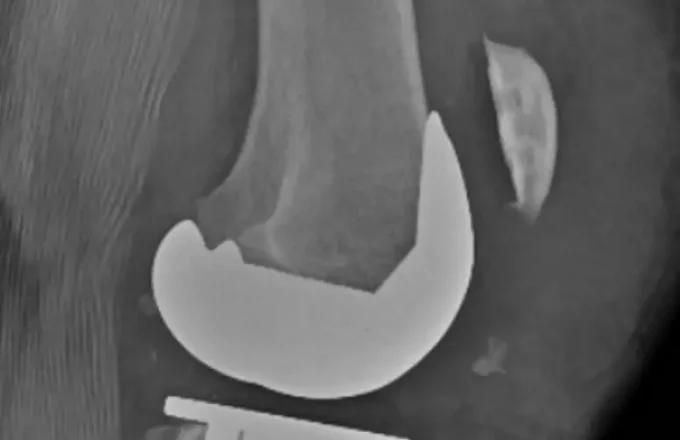Patellar tendon ruptures